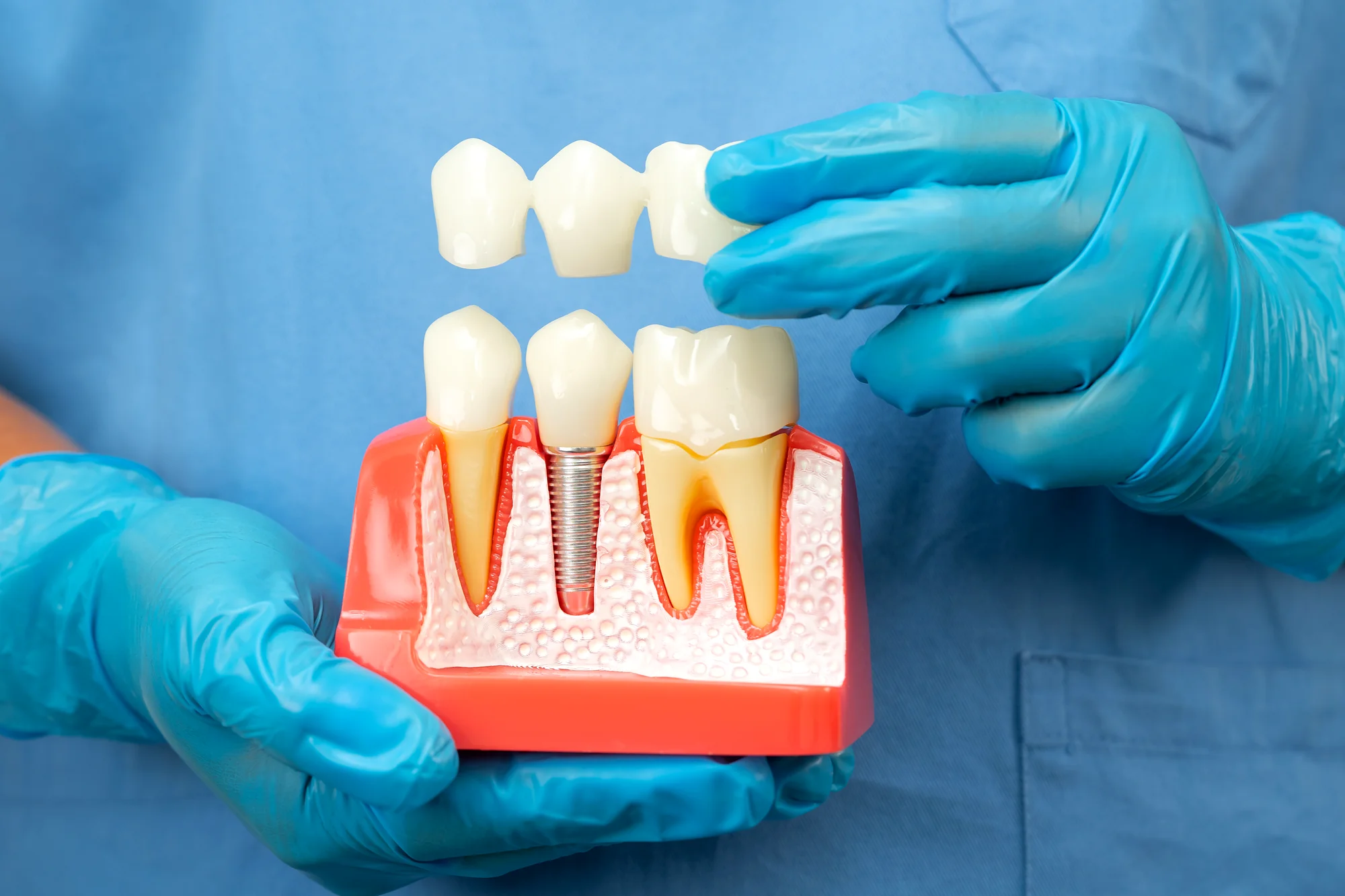 Dental implants Beaverton Oregon - permanent tooth replacement at Aloha Dental Implant & Surgical Center