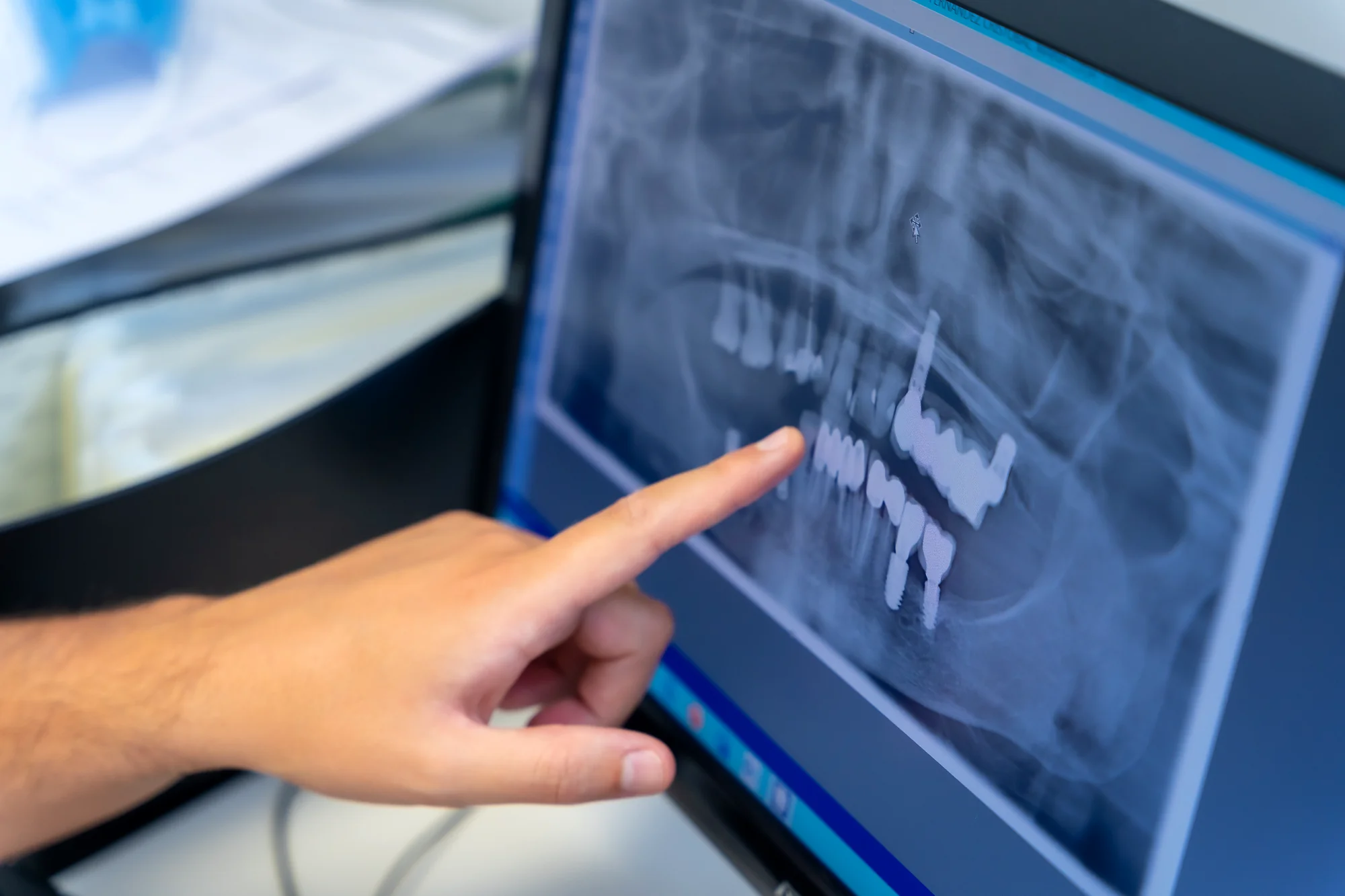 Wisdom teeth removal Beaverton - safe extraction with sedation